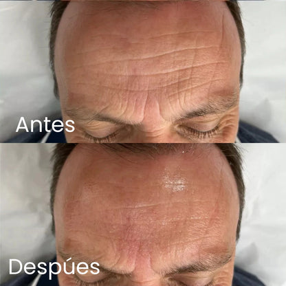 Hilos de Colágeno + Sérum 24k de Acido Hialuronico